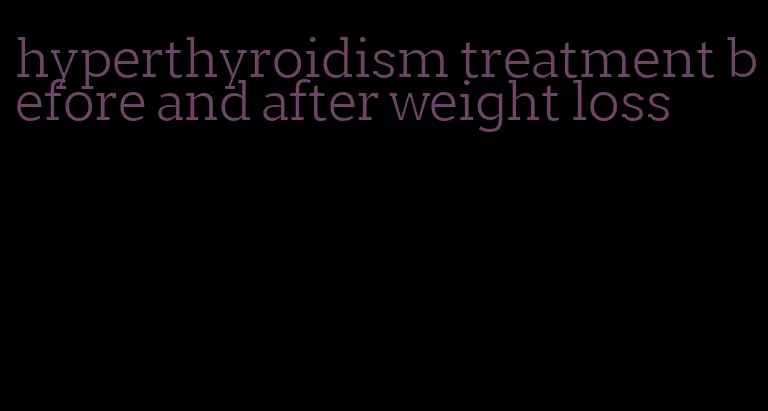 hyperthyroidism treatment before and after weight loss